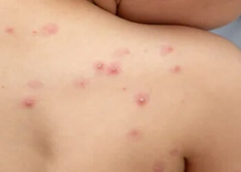 La OMS declaró emergencia internacional ante el aumento de casos de viruela del mono