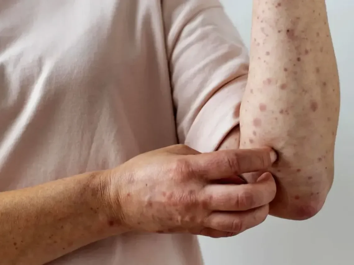 Epidemiología del Masvernat emitió una alerta sobre varios casos sospechosos de sarampión en la región