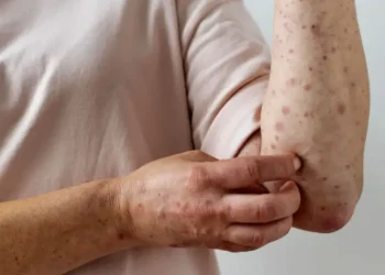 Epidemiología del Masvernat emitió una alerta sobre varios casos sospechosos de sarampión en la región