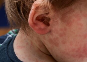 Ante la confirmación de un caso de sarampión, Salud convocó a comisión de vigilancia